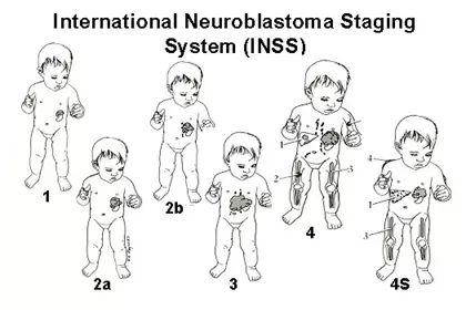 兒童神經母細胞瘤